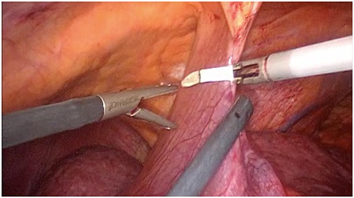 Tips of totally laparoscopic left hepatectomy