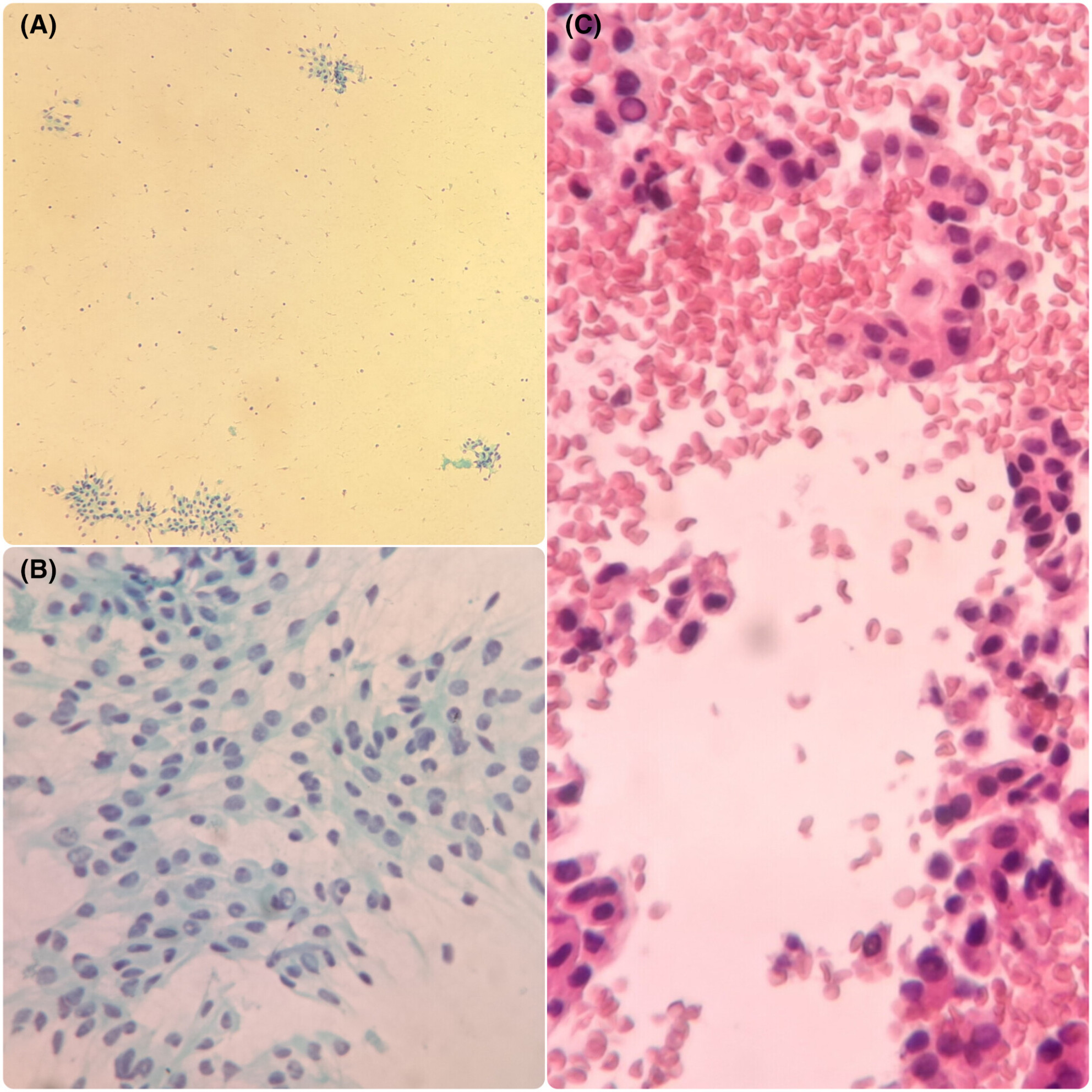 Striated duct adenoma: The cytological description of a rare entity