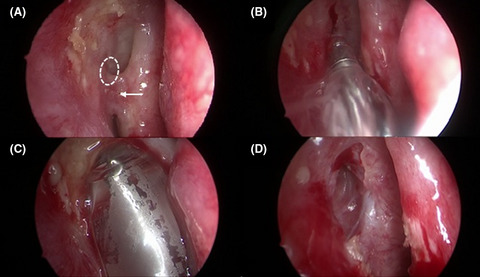 A case of endonasal balloon-assisted dacryoplasty after failure of endonasal dacryocystorhinostomy