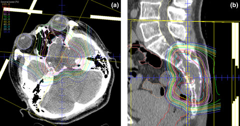 Proton beam therapy for bone sarcomas of the skull base and spine: A retrospective nationwide multicenter study in Japan