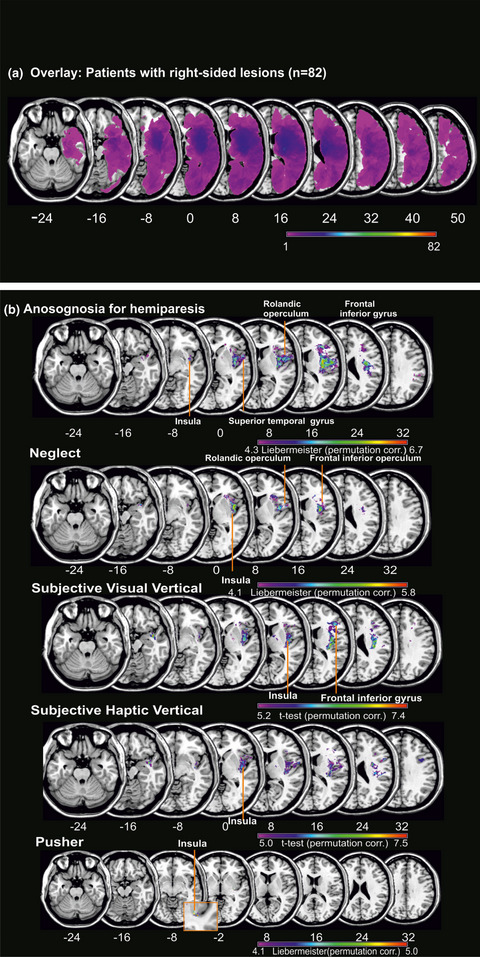 The importance of the insular cortex for vestibular and spatial syndromes