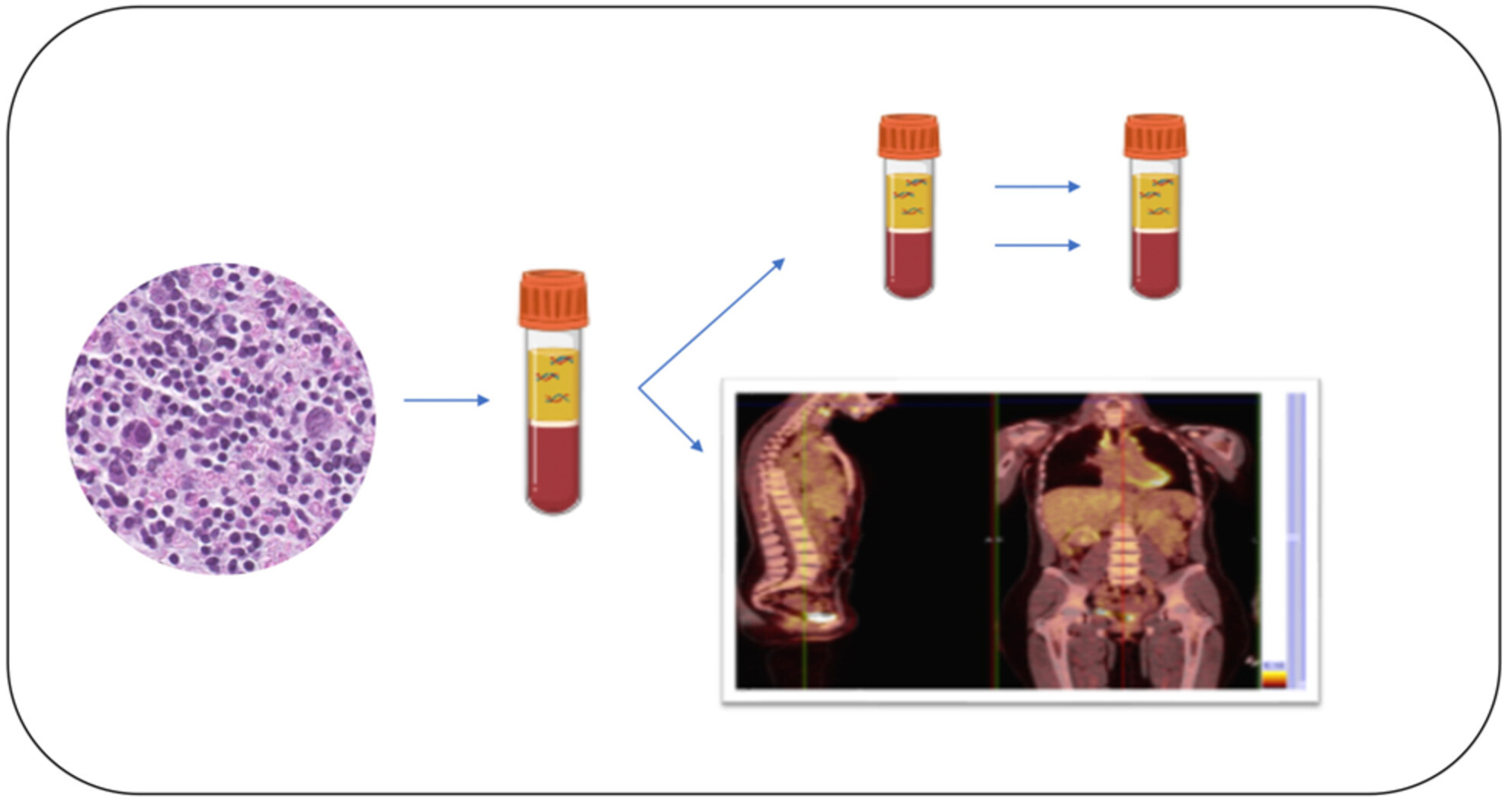 Liquid biopsy: A promising tool for driving strategies and predicting failures in patients with classic Hodgkin lymphoma