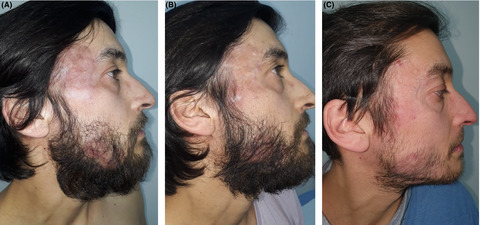 Primary cutaneous CD4-positive small/medium T-cell lymphoproliferative disorder: The first-reported Latin-American case with response to doxycycline