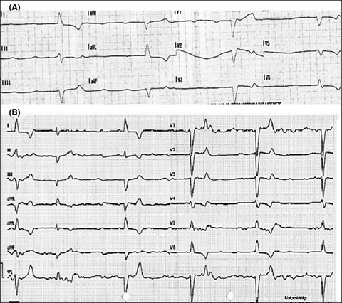 Hyperkalemia: A persisting risk. A case report and update on current management