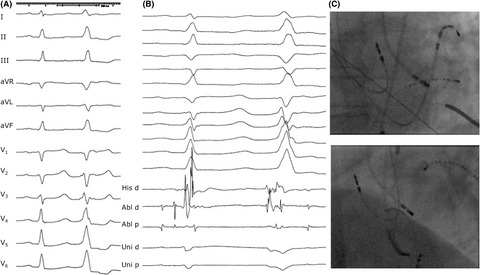 Catheter ablation of ventricular ectopy with para-hisian origin: importance of mapping both sides of the interventricular septum and understanding when to stop ablating