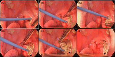 A prospective, randomized, single-blind study comparing coblation and monopolar extracapsular tonsillectomy