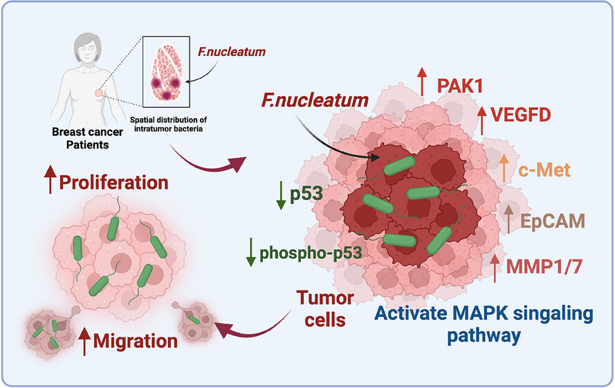 Integrated spatial multi-omics profiling of Fusobacterium nucleatum in breast cancer unveils its role in tumour microenvironment modulation and cancer progression