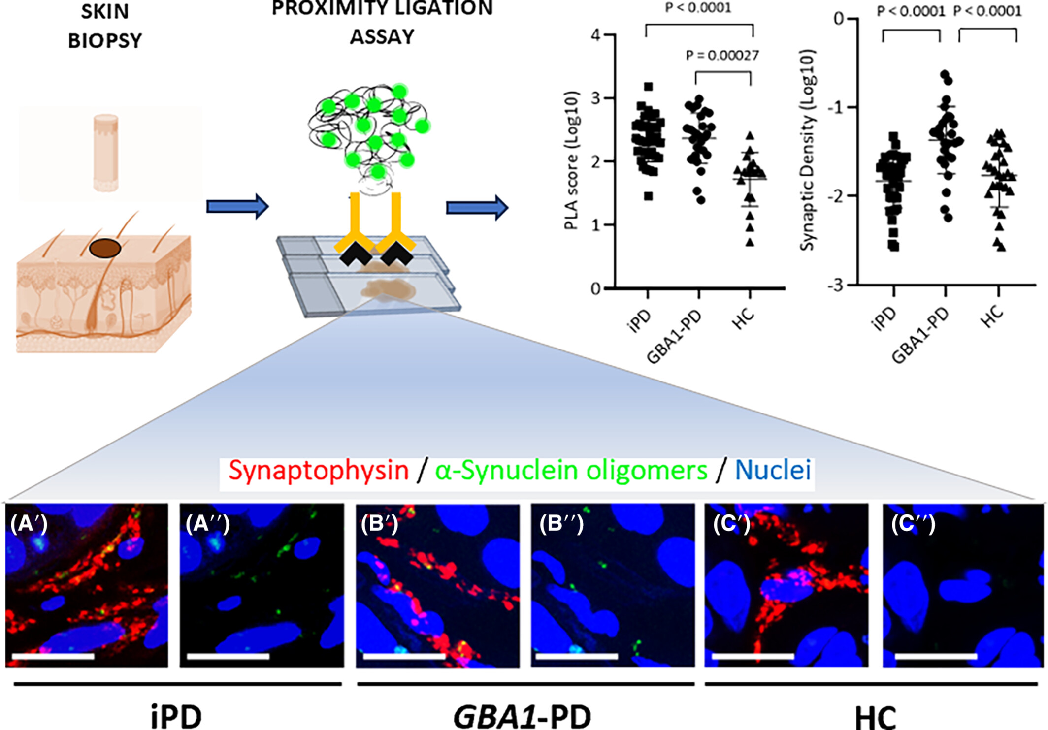 Comparing GBA1-Parkinson's disease and idiopathic Parkinson's disease: α-Synuclein oligomers and synaptic density as biomarkers in the skin biopsy