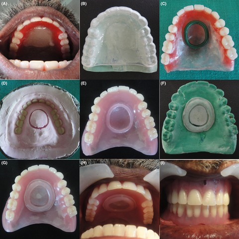 Functional salivary reservoir in maxillary complete denture – technique redefined