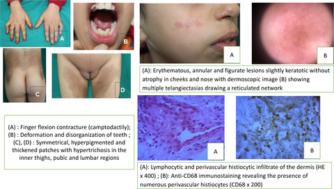 Unusual facial lesions in H syndrome