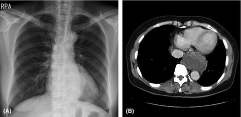 Benign posterior mediastinal schwannoma—Multiple diagnostic imaging modalities