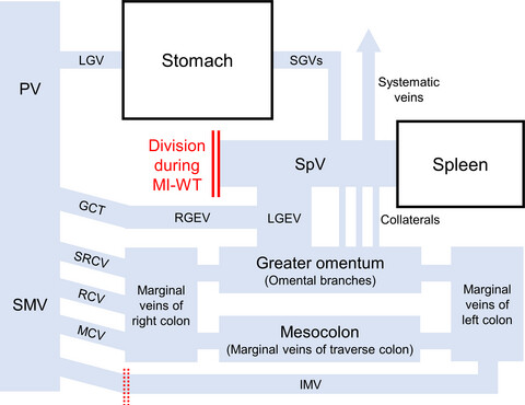 Precision vascular anatomy for minimally invasive distal pancreatectomy: A systematic review