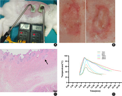 Effect of Bone Cement Thickness on the Risk of Scalded Skin in Joint Surgery