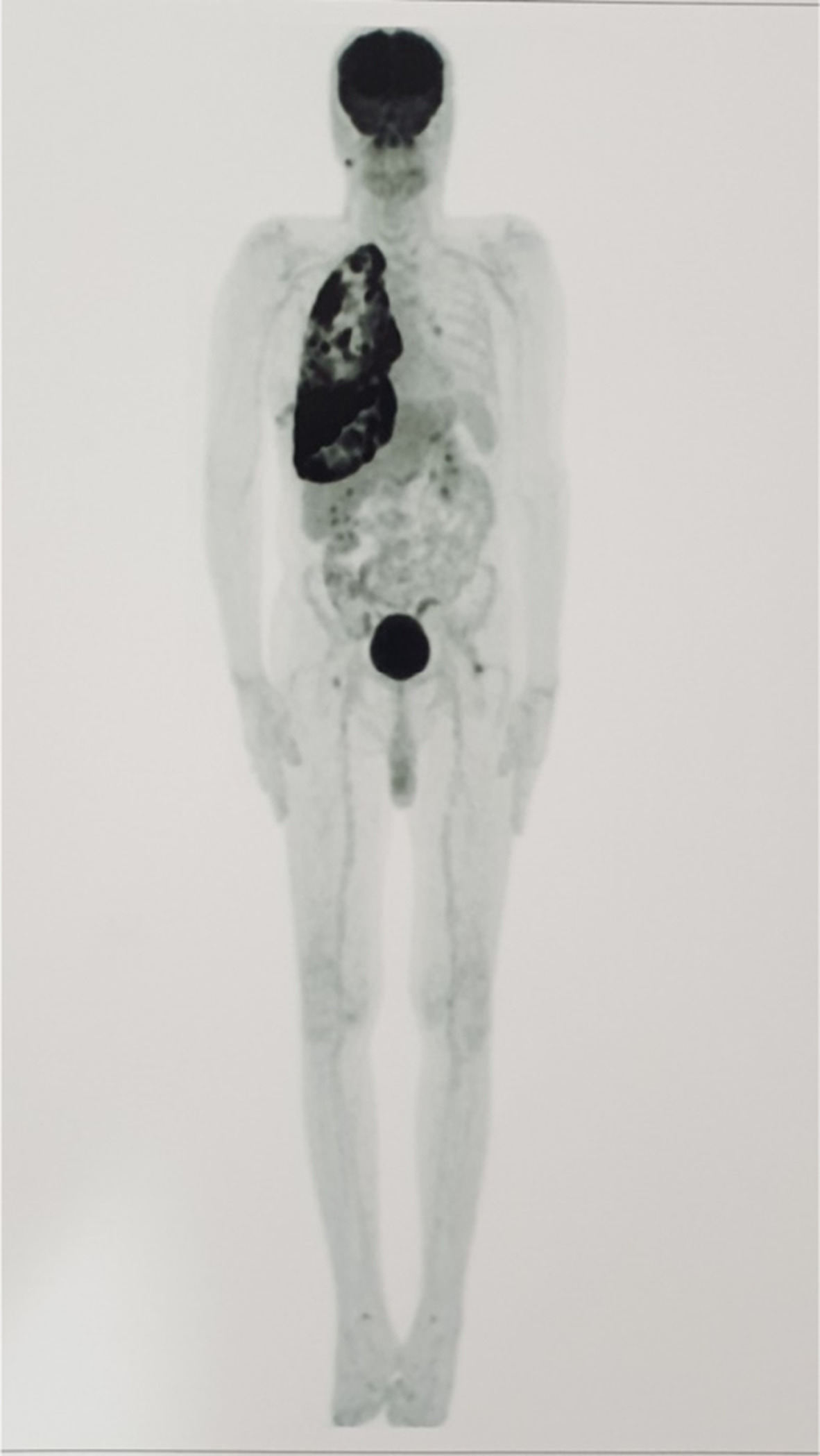 Primary malignant epithelioid hemangioendothelioma of the pleura: A review and report of a novel case