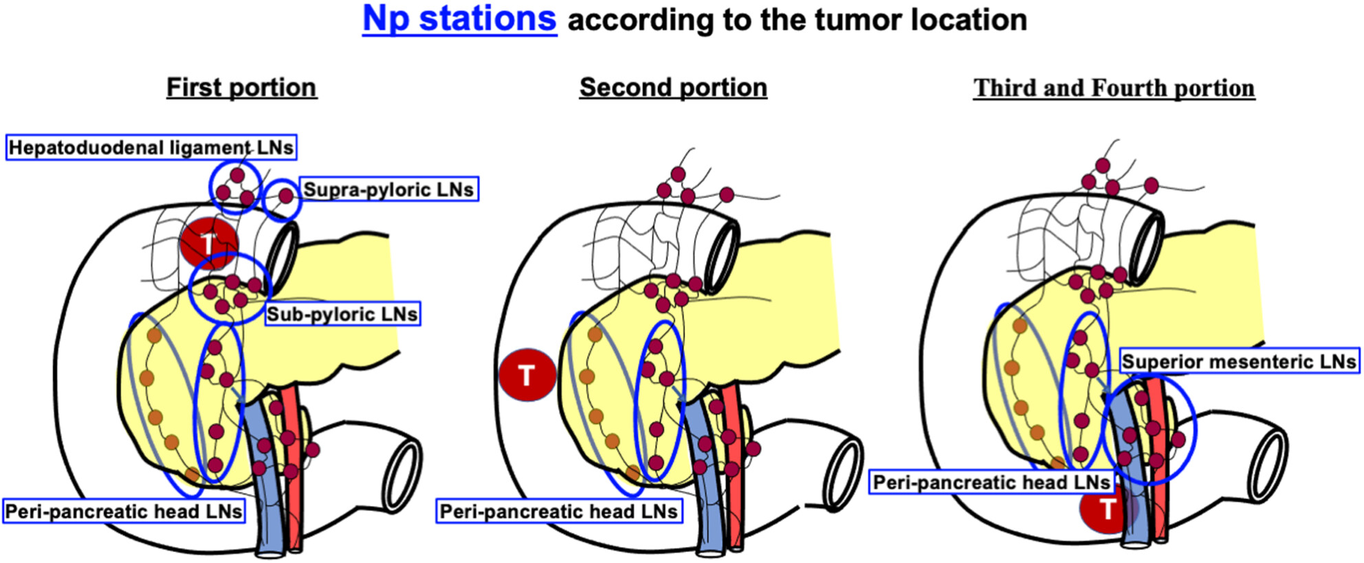 Efficacy of lymph node dissection for duodenal cancer according to the lymph node station