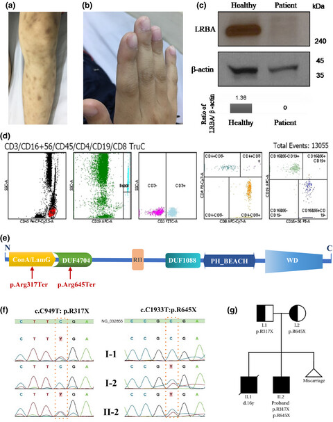 Novel compound heterozygous stop-gain mutations of LRBA in a Vietnamese patient with Common Variable Immune Deficiency