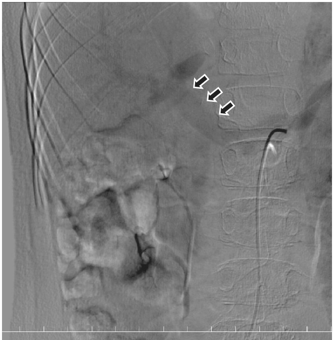 Progress of pulmonary hypertension and high manganese levels through congenital portosystemic shunt closure