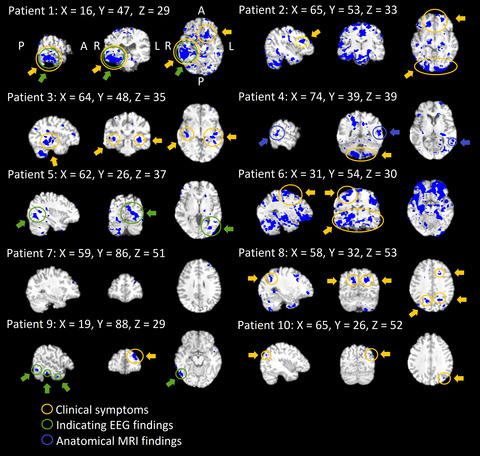 Altered physiological brain variation in drug-resistant epilepsy