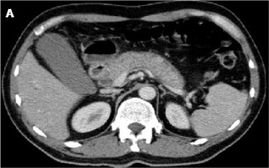 Autoimmune pancreatitis: What we know so far