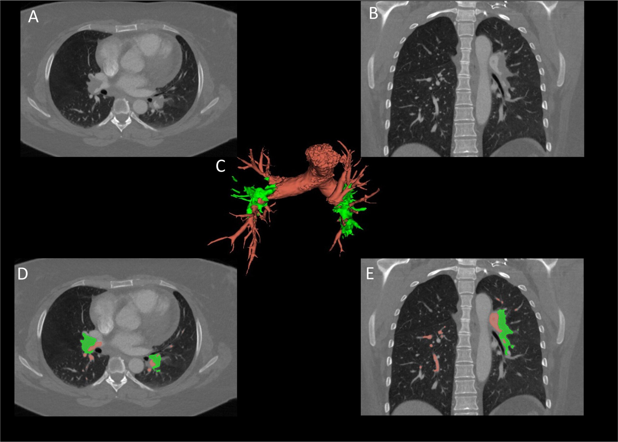 Imaging-based risk stratification of patients with pulmonary embolism based on dual-energy CT-derived radiomics
