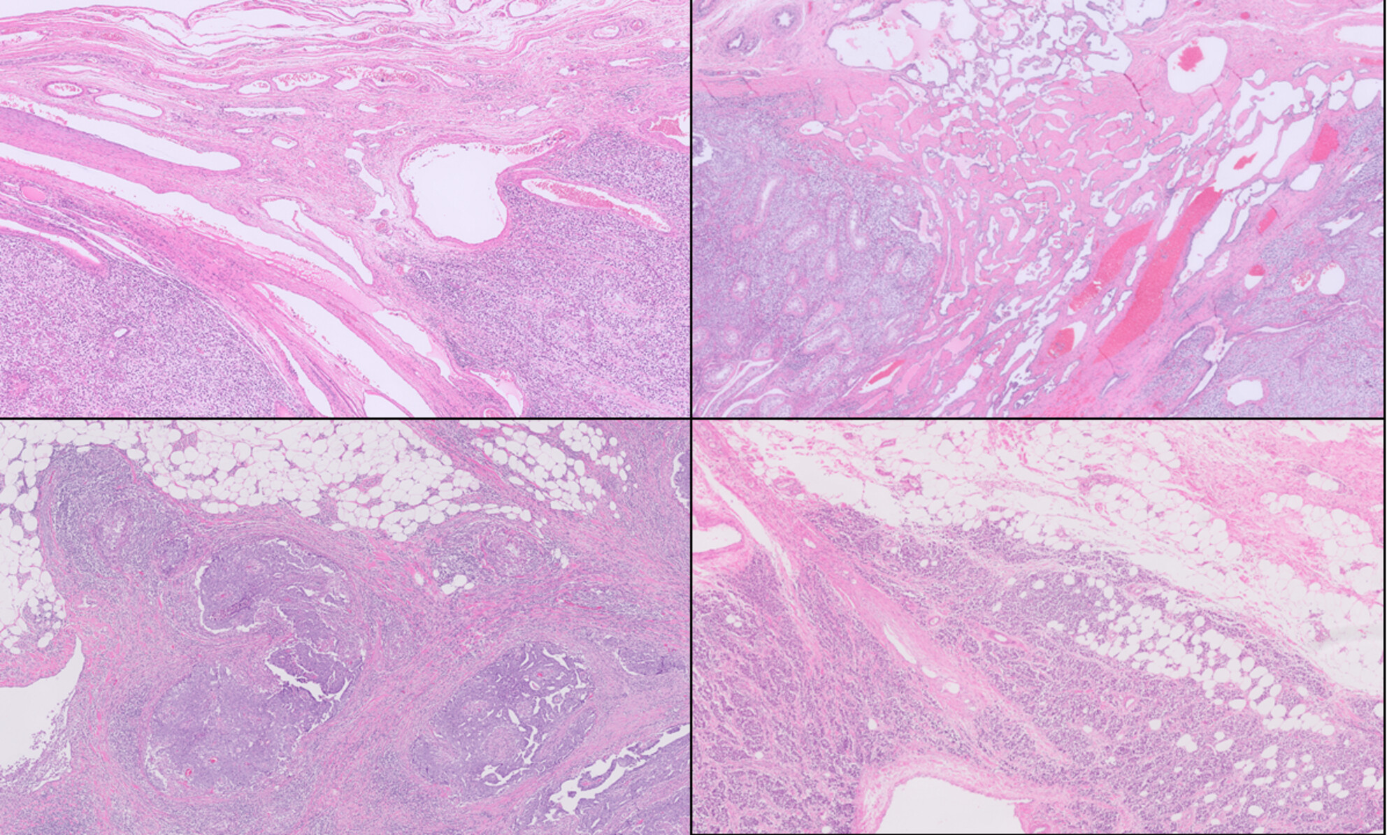 Interobserver reproducibility of hilar soft tissue invasion in testicular germ cell tumours among genitourinary pathologists