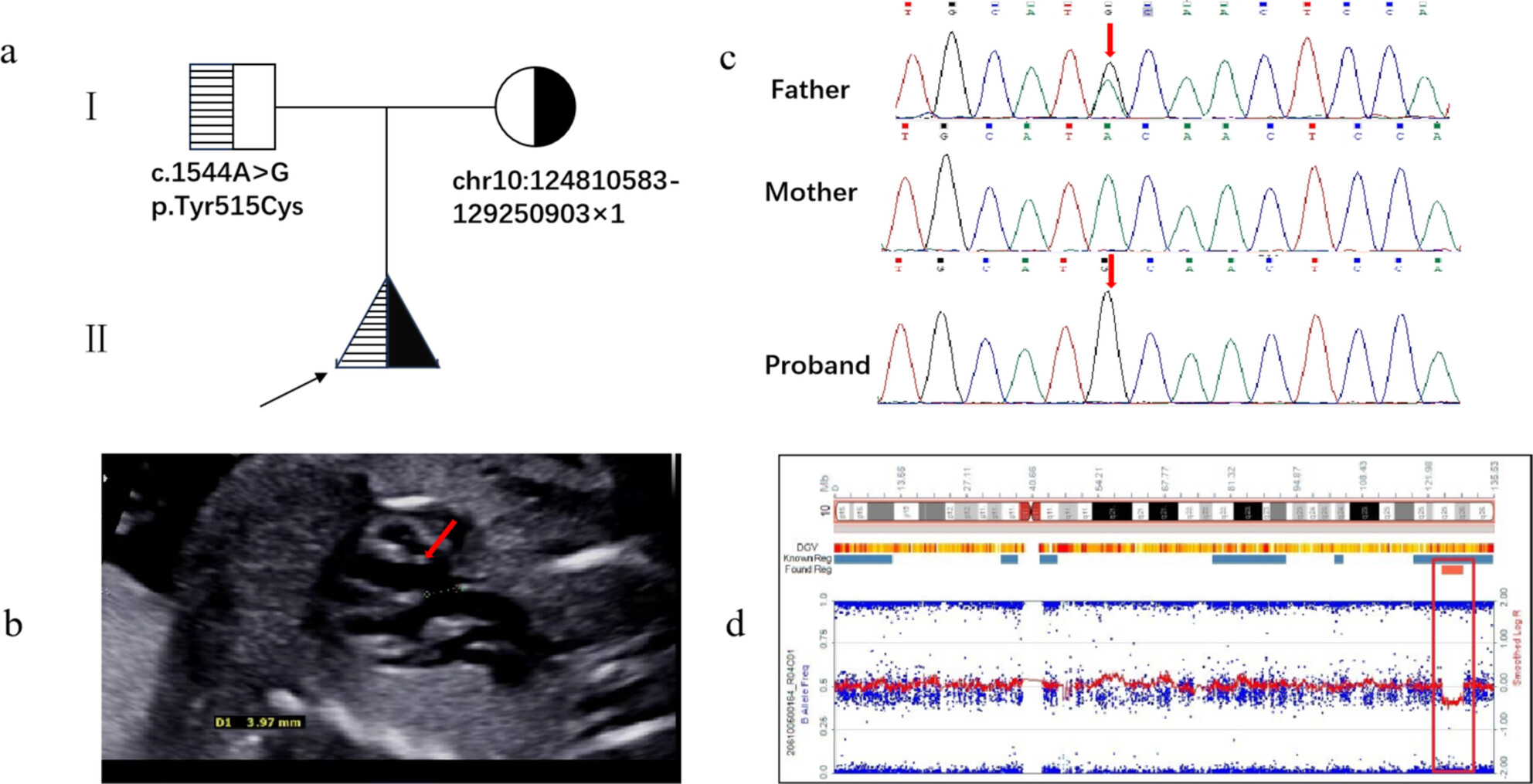 Unmasking a Recessive Allele by a Rare Interstitial Deletion at 10q26.13q26.2: Prenatal Diagnosis of MMP21 -Related Disorder and Further Refine INSYN2A Involvement in the Postnatal Cognitive Phenotype