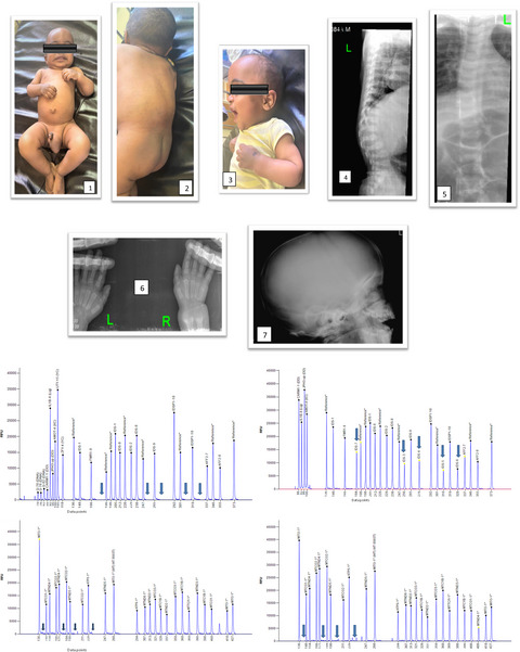 A 1-year and 4-month-old child with mucopolysaccharidoses type II: A clinical case report from Ethiopia