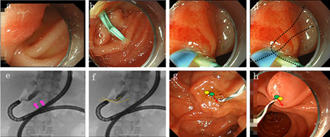 Novel technique using pancreatic duct stent facilitates difficult biliary cannulation in patients with Roux-en-Y anatomy (with video)