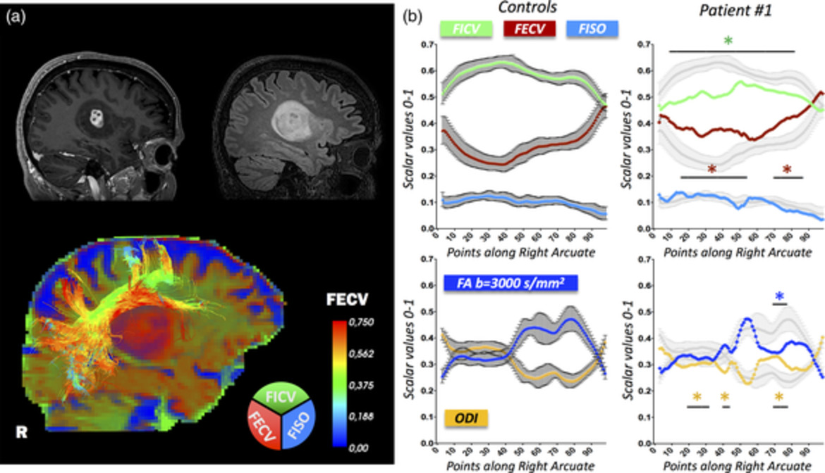 Along-tract statistics of neurite orientation dispersion and density imaging diffusion metrics to enhance MR tractography quantitative analysis in healthy controls and in patients with brain tumors