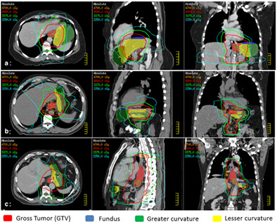 Trimodality therapy for esophageal cancer: The role of surgical and radiation treatment parameters in the development of anastomotic complications