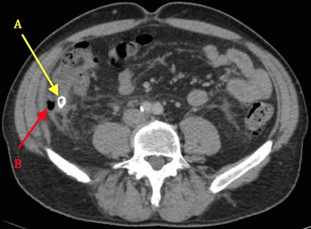 Snapshot quiz – recurrent right iliac fossa pain in the patient with a previous history of appendicitis