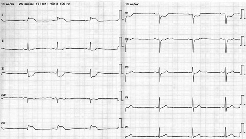 Cardiac arrest during spinal anesthesia for cervical conization: a case report