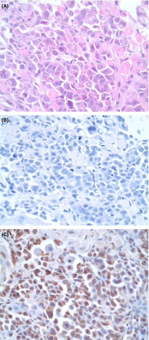 A patient with solid gynecologic cancer causing lactic acidosis, severe hypercalcemia, and hypoglycemia