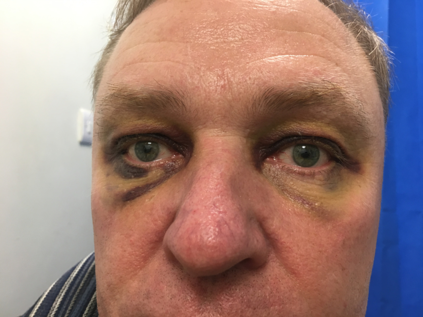 A man with panda eyes after a fall