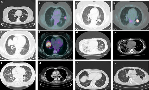 Clinical and radiological characteristics of patients with pulmonary marginal zone lymphoma: A single center analysis
