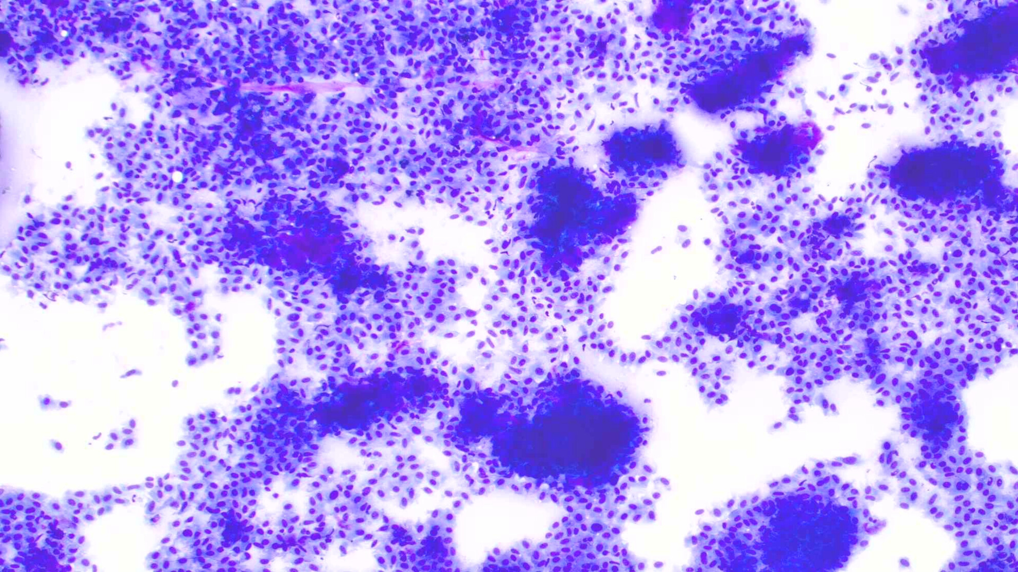 Myoepithelial-Rich Pleomorphic Adenoma With Novel PLAG1 Inversion on Chromosome 8, and LRP1B, PBRM1 and TCF3 Mutations