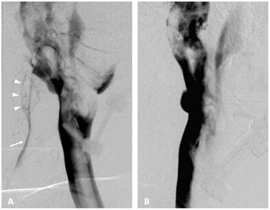 CSF-Venous Fistula of the Clival Skull Base: A Unique Case Study and Literature Review