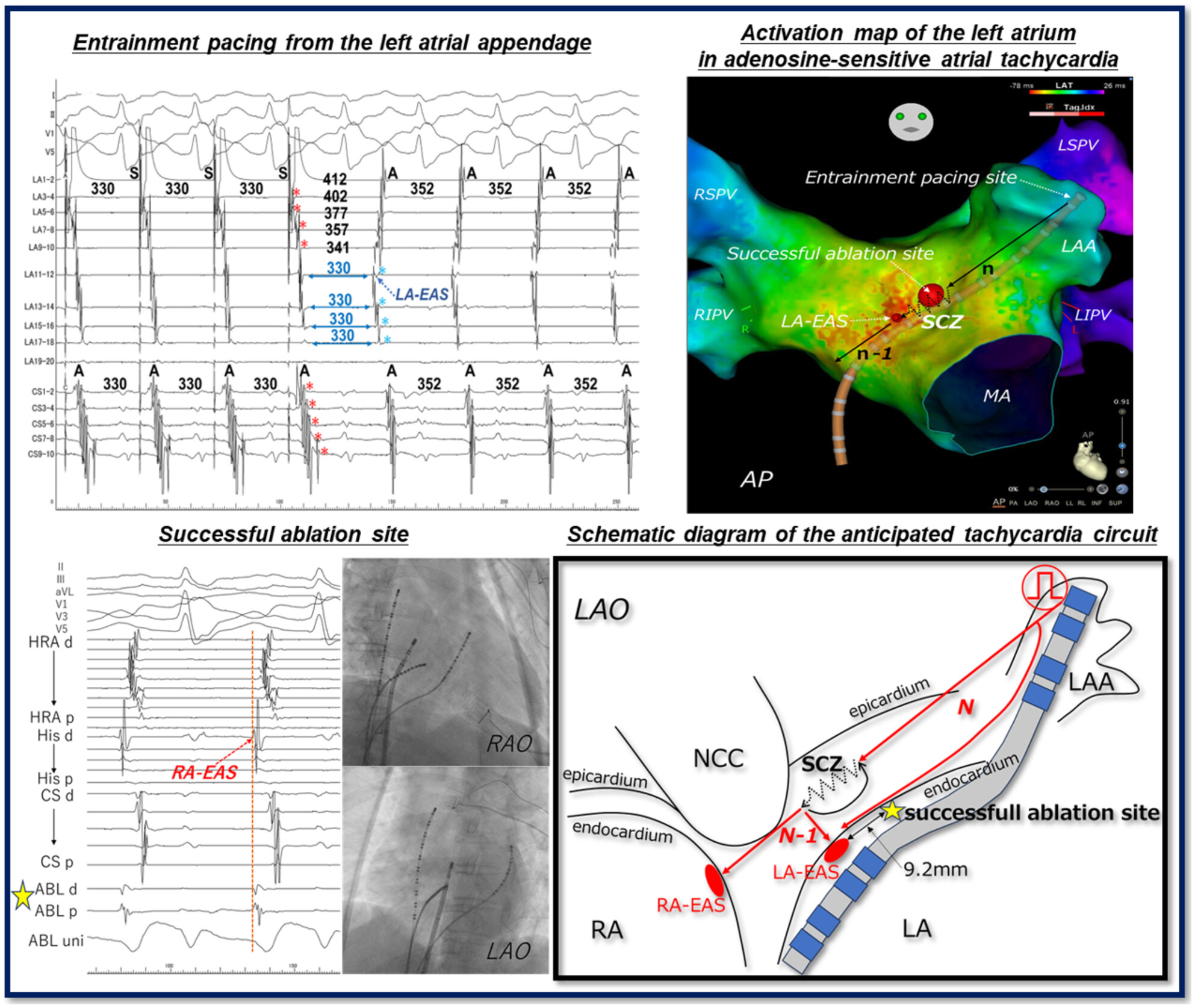 Unusual left-sided variant orientation of the slow conduction zone in adenosine-sensitive atrial tachycardia