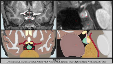 Dehydroepiandrosterone mediates associations between trauma-related symptoms and anterior pituitary volume in children and adolescents