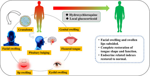 A case of Melkersson-Rosenthal syndrome with endocrine disorders: Extraordinary efficiency of hydroxychloroquine and mechanism hypothesis