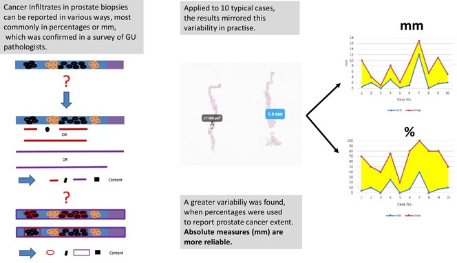 Unexpectedly high variability in determining tumour extent in prostatic biopsies: implications for active surveillance