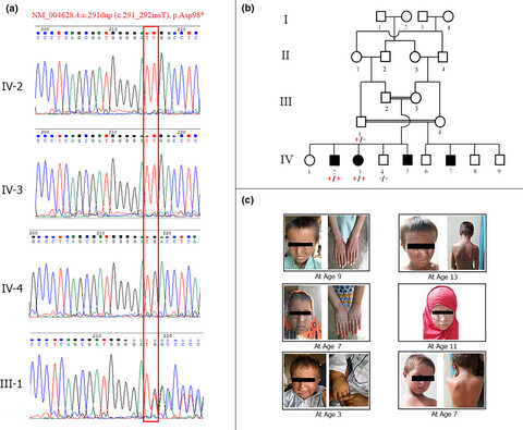 Identification of a novel protein truncating mutation p.Asp98* in XPC associated with xeroderma pigmentosum in a consanguineous Pakistani family