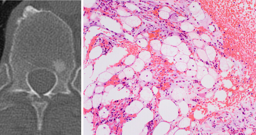 Intraosseous hibernoma: clinicopathologic and imaging analysis of 18 cases