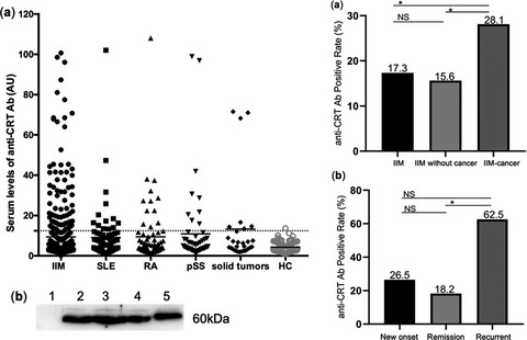 A novel autoantibody targeting calreticulin is associated with cancer in patients with idiopathic inflammatory myopathies