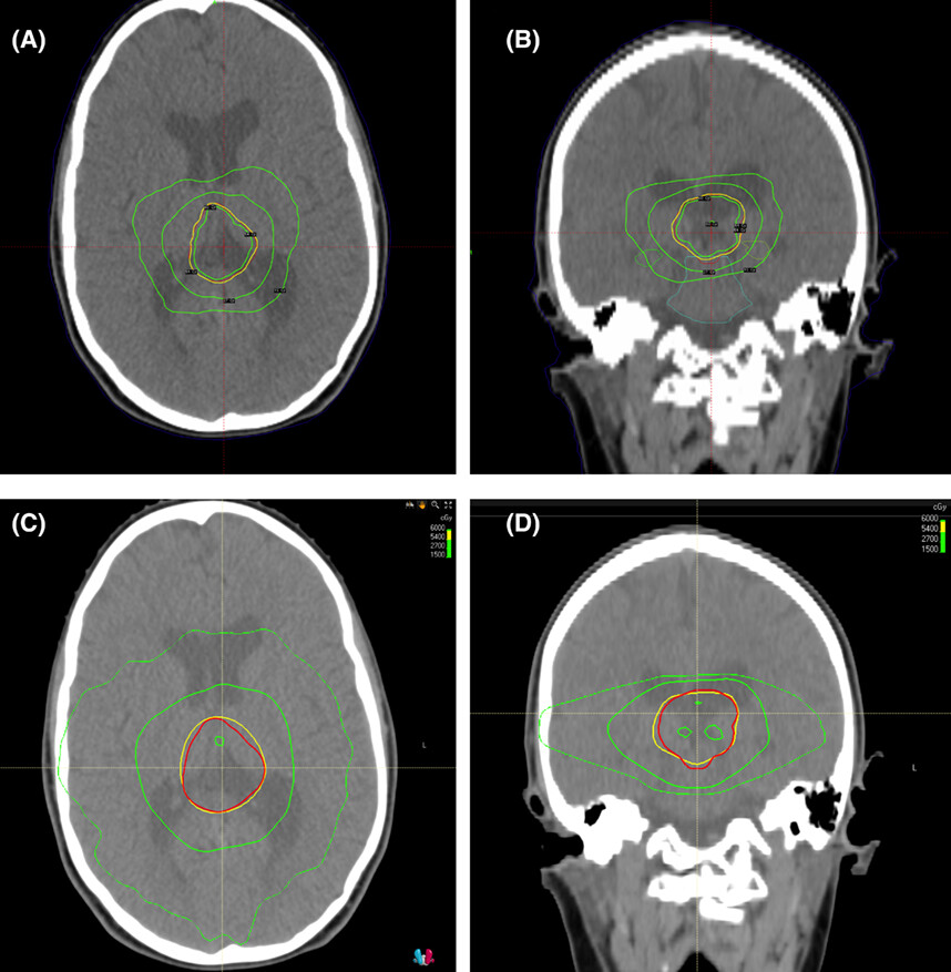 Dosimetric evaluation of adult and paediatric brain tumours planned using mask-based cobalt-60 fractionated stereotactic radiotherapy compared to linear accelerator-based volumetric modulated arc therapy
