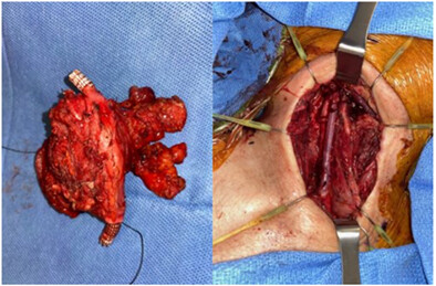 Outcomes Following Treatment for Carotid Blowout in Head and Neck Cancer Patients