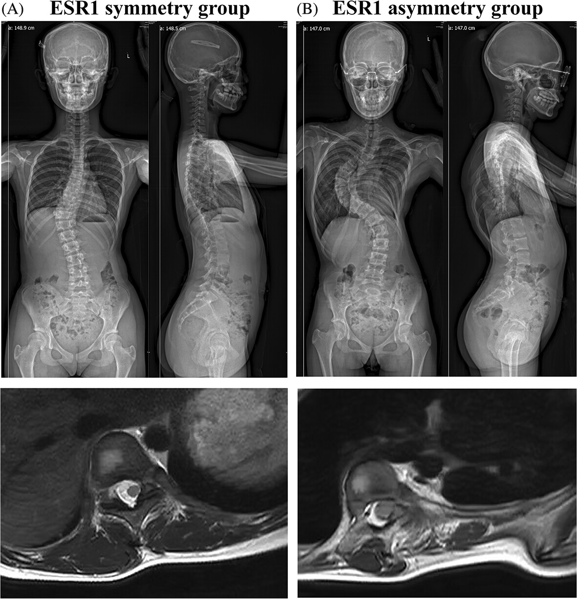 Distinct clinical characteristics of adolescent idiopathic scoliosis with asymmetrical ESR1 expression in paraspinal muscle progenitor cells