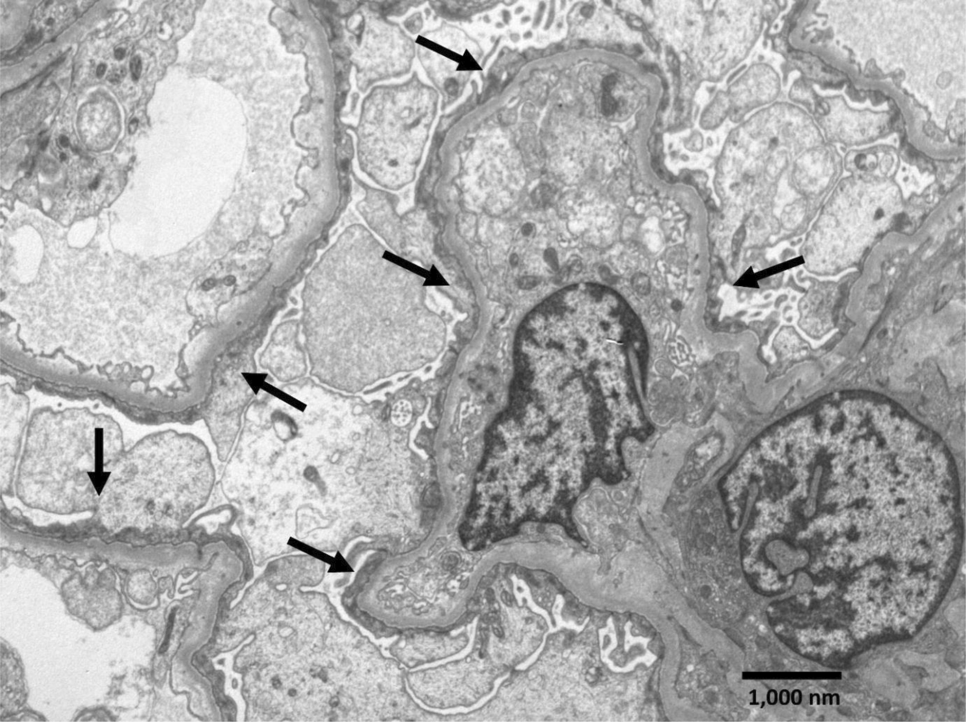 Relapsing nephrotic syndrome with acute renal failure following a unique episode of multiple bee stings: A case report