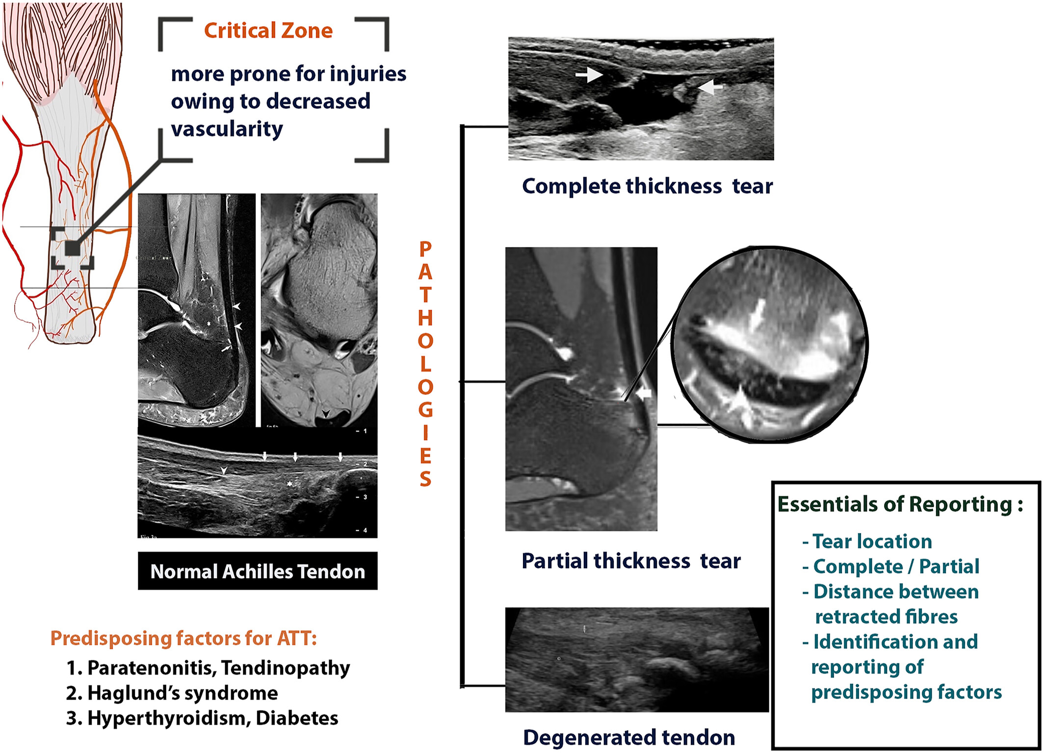 Key imaging perspectives on Achilles tendon tears—A radiological roadmap: Pictorial essay