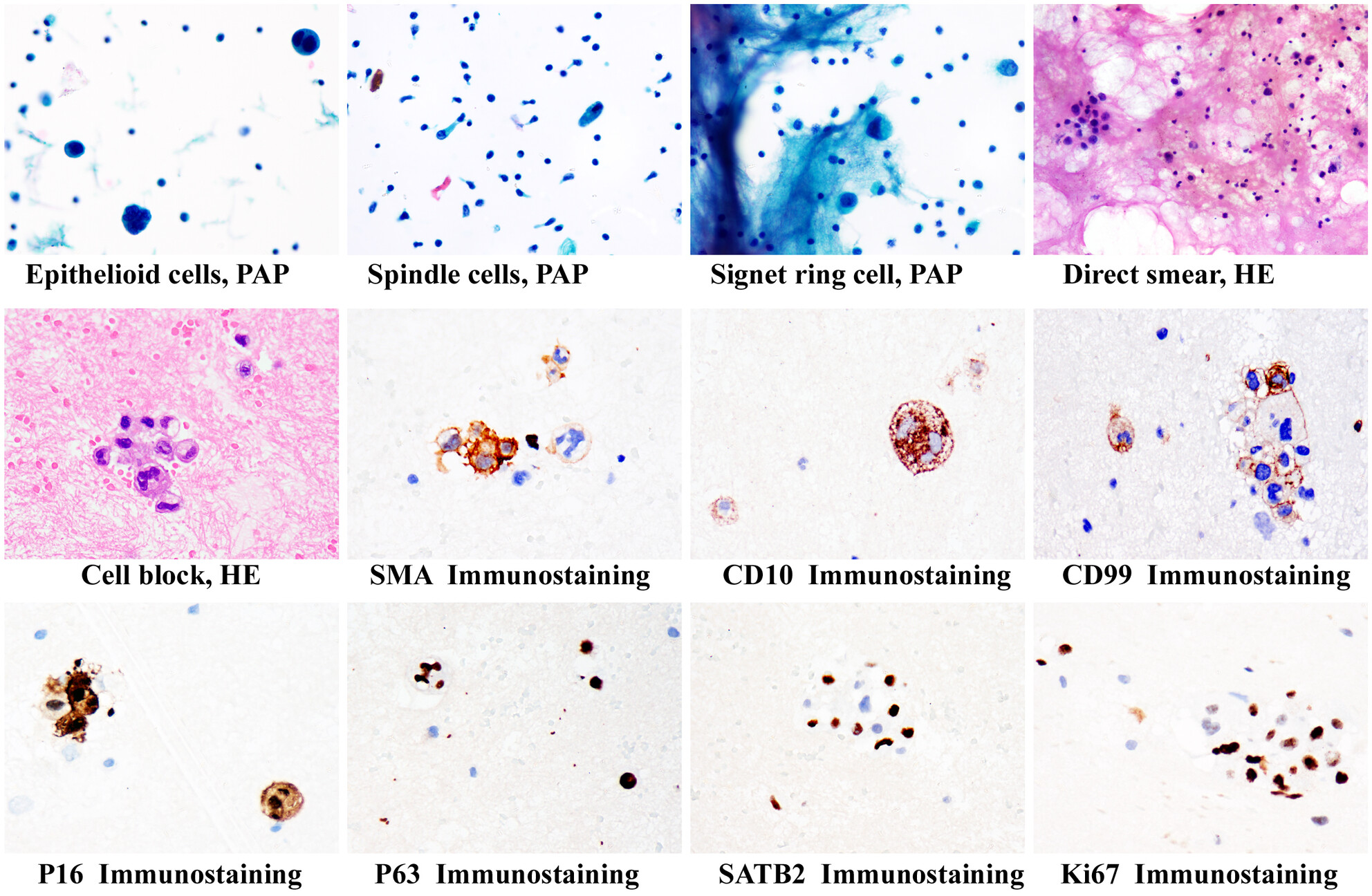 Cytomorphological and Immunohistochemical Features of Metastatic Malignant Phyllodes Tumour in Pleural Fluid: A Case Report With Literature Review